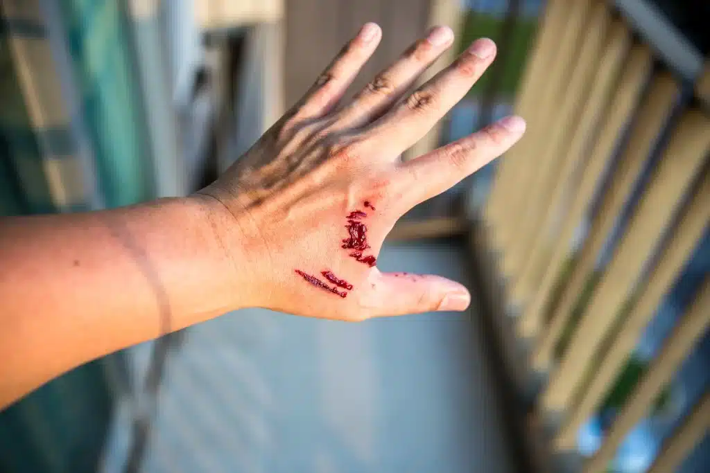 A hand that has been bitten by a dog.